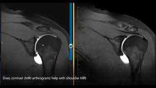 Does MRI arthrogram help see the labrum [upl. by Hennessy]