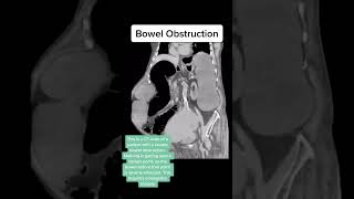 Bowel obstruction on CT scan [upl. by Lunsford490]