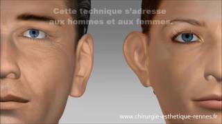 Technique earfold Oreilles décollées par le Dr Delliere [upl. by Amikat]