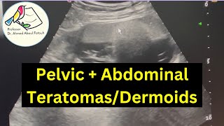 Ultrasound of Pelvic amp Abdominal Teratomas amp Dermoids sonographer radiologist gynecologists [upl. by Magnum]