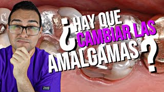 RESINA 💎 Vs AMALGAMA DENTAL🌡️ ¿Debo CAMBIAR 🤔 PREGUNTAS Y RESPUESTAS [upl. by Nezah600]