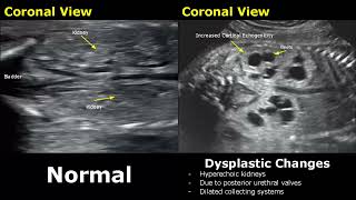 Fetal Kidneys Ultrasound Normal VS Abnormal Image Appearances  Kidney Abnormalities USG  ObGynae [upl. by Dex124]