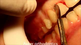 Circumferential supracrestal fiberotomyCSF in rotated teeth after finishing orthodontic treatment [upl. by Anivle]