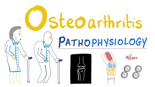 Osteoarthritis OA  Pathophysiology  Rheumatology Series [upl. by Ahsenev858]