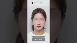 Korean Double Jaw Surgery  VLine Surgery  Zygoma Reduction Surgery Results  Before amp After [upl. by Jeff478]