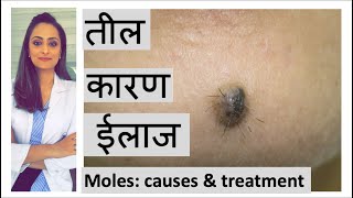 How to remove mole  तील के कारण और इलाज  home remedy Hindi  त्वचा के डॉक्टर [upl. by Evander]