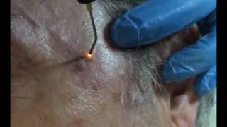 Plasmage  Treatment Fibroma Lentigo [upl. by Anuaik]