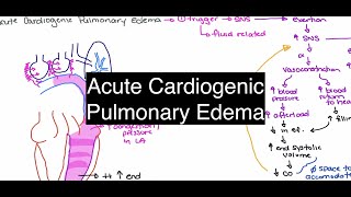 Acute Cardiogenic Pulmonary Edema [upl. by Oicnerolf490]