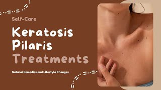 Spavelous Talks Keratosis Pilaris Treatments SelfCare for Chicken Skin [upl. by Syah161]