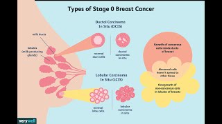 Treatment of Ductal Carcinoma in Situ [upl. by Eerdna650]