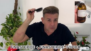 FINASTERIDE  MINOXIDIL TÓPICO Experiencia personal 4 meses de uso [upl. by Mal950]