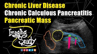 Chronic Liver Disease  Chronic Calculous Pancreatitis  Pancreatic Mass  Ultrasound  Case 189 [upl. by Nahgeem]