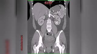 AVMArteriovenous malformations in left kidney [upl. by Russi614]