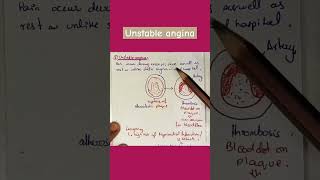 Unstable angina stable angina variant angina angina medical [upl. by Wons]