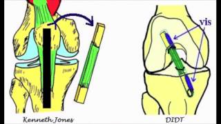 Bases anatomiques du ligament croisé antérieur [upl. by Gunn908]