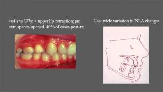 Treatment and stability of Class II Division 2 malocclusion in children and adolescents [upl. by Eciral]