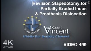 Revision Stapedotomy for Partially Eroded Incus amp Prosthesis Dislocation [upl. by Bundy]