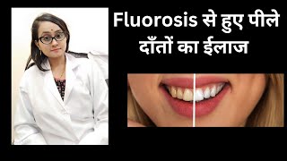 Treatment of yellow teeth due to fluorosis [upl. by Kwon]