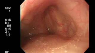 Endoscoe insertion from right pyriform sinus [upl. by Branscum]