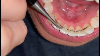 “POST BRACES” Fixing Bonded Retainer [upl. by Eixirt]