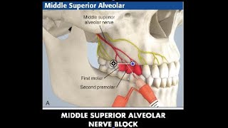 5  Middle Superior Alveolar Nerve Block Dr Simon Amir [upl. by Ettevi278]