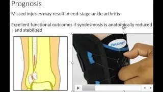 Ankle Syndesmosis Conservative Treatment with Aircast Airsport ankle brace [upl. by Enitsej]