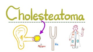 Hearing Loss Deafness  Cholesteatoma  Causes Symptoms Diagnosis amp Treatment  ENT  Pathology [upl. by Mord]