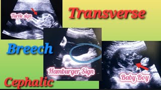 Transverse Breech amp Cephalic Baby In Uterus Genderreveal  Anterior Posterior Placenta Baby Gender [upl. by Aw]