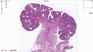 Tubular adenoma  Colon  Histopathology [upl. by Archle519]