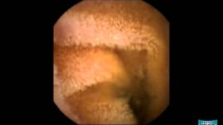 Inflammatory Lesions in the Small Bowel [upl. by Bergman327]