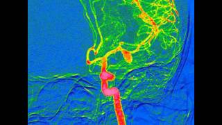 Brain aneurysm angiography [upl. by Thormora247]