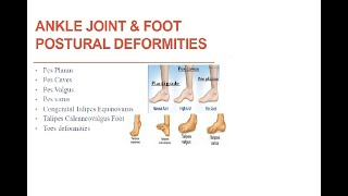 ankle amp foot deformities [upl. by Buchbinder]