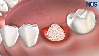 PostOp Instructions Bone Grafting at Naperville Oral Surgery amp Dental Implants [upl. by Sofer]