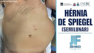 HÉRNIAS ABDOMINAIS Parte 6 SPIEGEL SEMILUNAR 👨🏽‍⚕️🚑 Joao Fonseca Cir Geral [upl. by Sonnnie970]