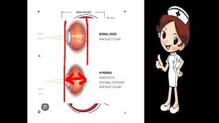 HYPERMETROPIA HYPEROPIA 2 [upl. by Adiesirb]