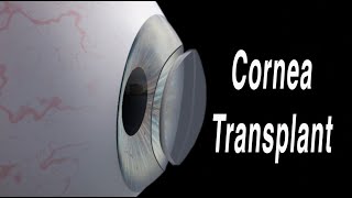 Cornea Transplant Penetrating Keratoplasty [upl. by Chadabe]