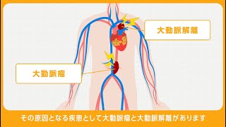 解離性大動脈瘤・胸部大動脈瘤腹部大動脈瘤（症状と対応、入院から退院まで） [upl. by Epp846]