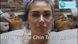 Get Rid of Double Chin PDO Thread Lift  Harley Street Treatment [upl. by Jalbert]