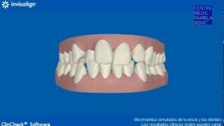 Simulación Invisalign® [upl. by Lundquist473]