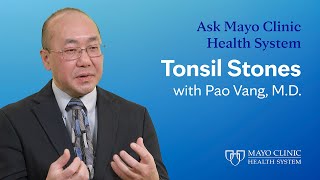 All About Tonsil Stones Ask Mayo Clinic Health System [upl. by Villiers]