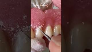 Improving a Denture with Festooning denture dentallab festoon [upl. by Eltsyrhc]