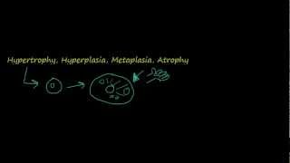 2  Introduction to pathology  hypertrophy hyperplasia [upl. by Alam]