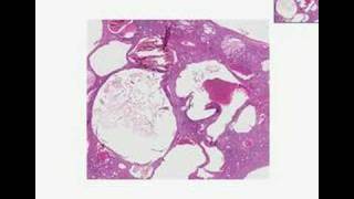 Histopathology KidneyAdult polycystic disease [upl. by Ansilme854]