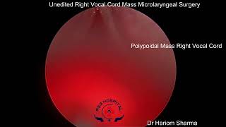 Microlaryngeal Surgery  Voice Surgery  MLS Surgery  Vocal Cord Polyp Surgery [upl. by Harlin162]