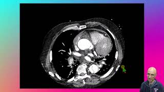 Type A Aortic Dissection with Shared Sheath Rupture [upl. by Haeluj]