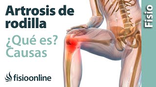 Artrosis o desgaste de rodilla  Qué es causas síntomas y tratamiento [upl. by Ahsekel]