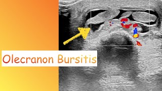 Olecranon Bursitis Ultrasound [upl. by Tj]