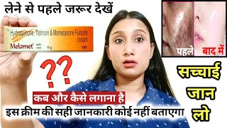 Melamet CreamUsesSide effectsReviewMelamet Cream Remove PigmentationMelasma How to use in Hindi [upl. by Gurevich]