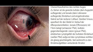 Beidseitige Bindehautentzündung Konjunktivitis im Verlauf einer Affenpockeninfektion [upl. by Ayotan615]