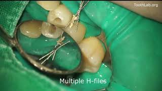 Root canal retreatmentGutta percha removal [upl. by Ecydnarb]